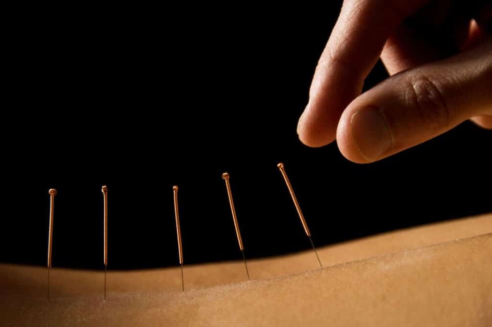 acupuncture pour la prostatite