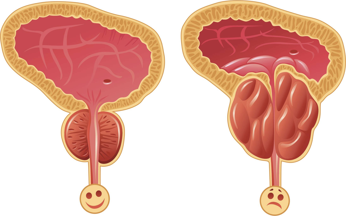 Comment déterminer la présence de prostatite