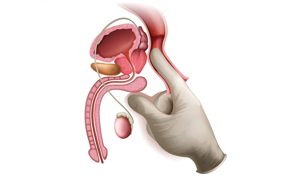 Massage de la prostate