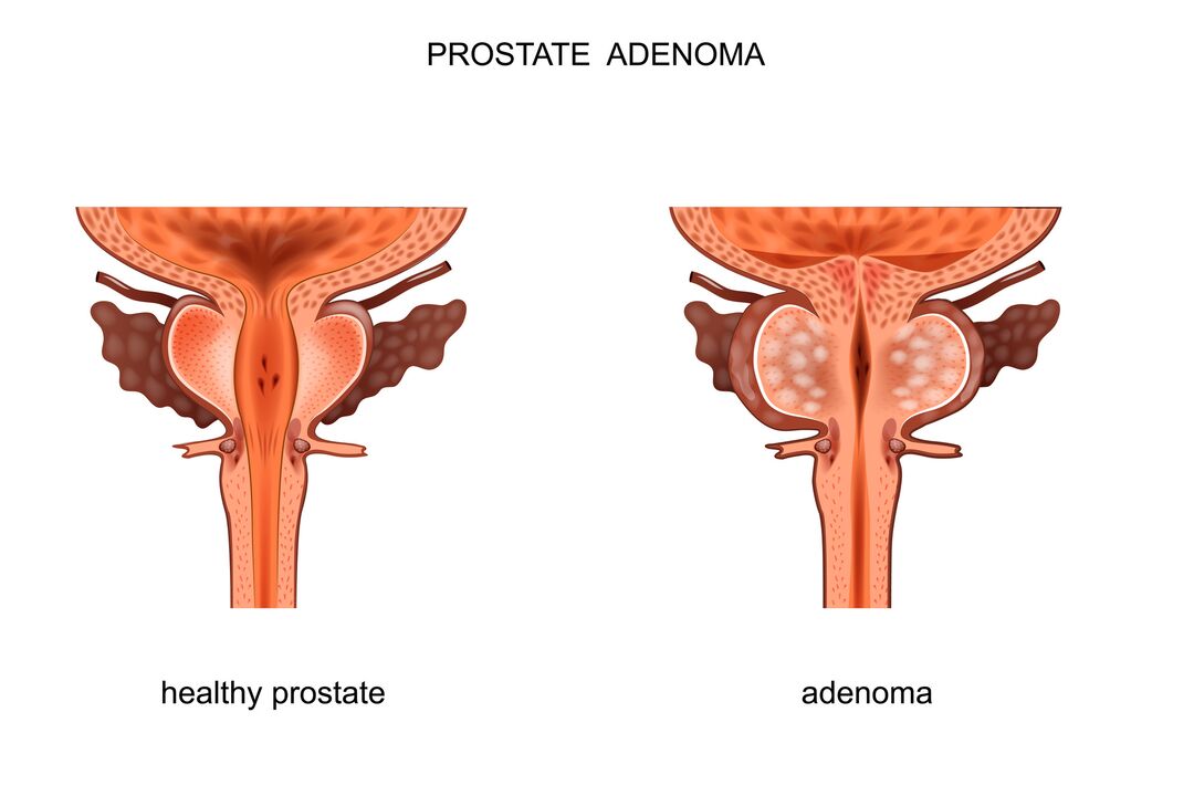 Prostate sain et adénome
