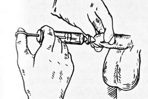 instillations pour la prostatite