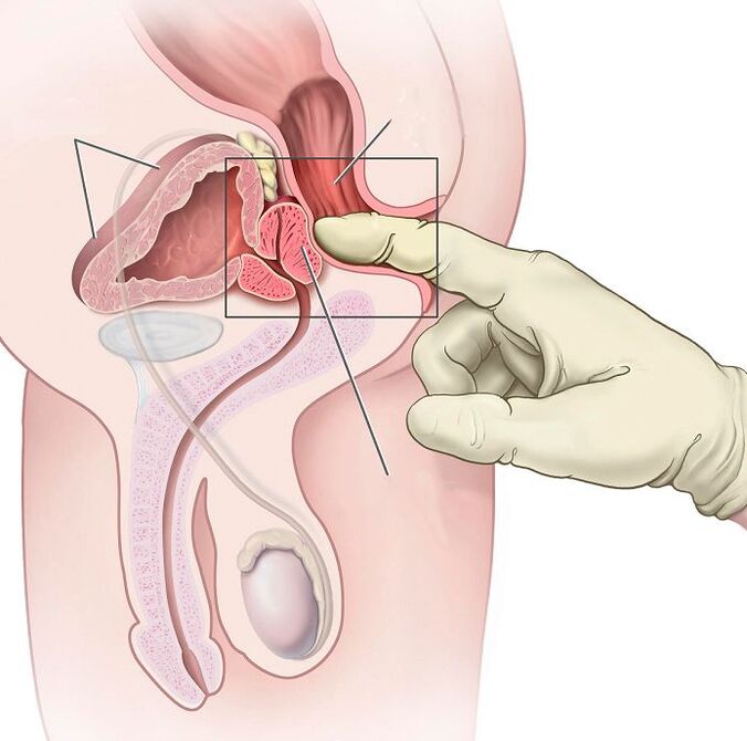 Massage de la prostate pour le traitement de la prostatite