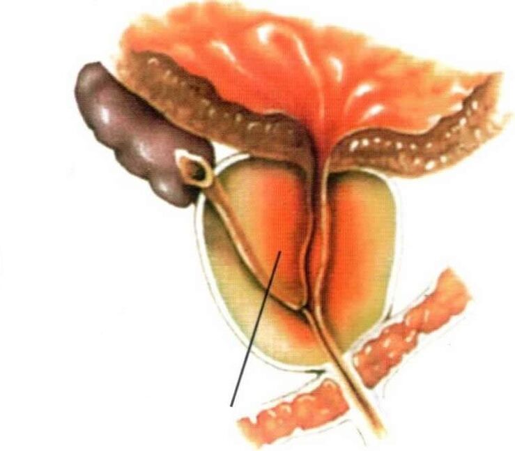 Inflammation du tissu prostatique dans la prostatite chronique